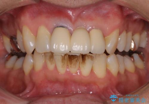 数十年ぶりに歯のお掃除の症例 治療前