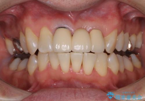 数十年ぶりに歯のお掃除の症例 治療後