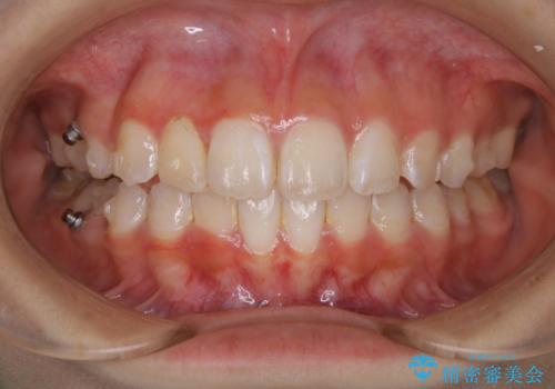 矯正中のクリーニング(PMTC)の治療前