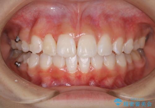 矯正中のクリーニング(PMTC)の治療後