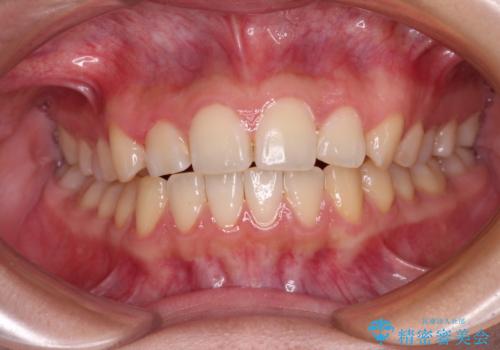 カリエール・ディスタライザーとインビザラインを用いた奥歯の咬み合わせ改善の治療中