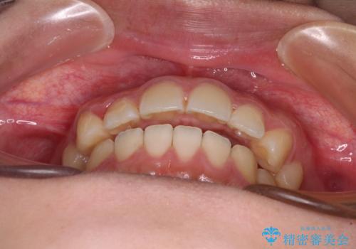 カリエール・ディスタライザーとインビザラインを用いた奥歯の咬み合わせ改善の治療中