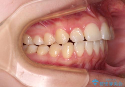 カリエール・ディスタライザーとインビザラインを用いた奥歯の咬み合わせ改善の治療中