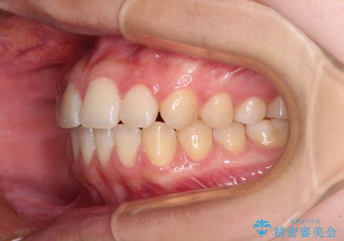 カリエール・ディスタライザーとインビザラインを用いた奥歯の咬み合わせ改善の治療中