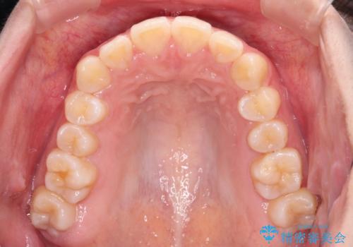 カリエール・ディスタライザーとインビザラインを用いた奥歯の咬み合わせ改善の治療中
