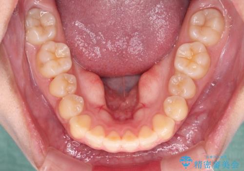カリエール・ディスタライザーとインビザラインを用いた奥歯の咬み合わせ改善の治療中