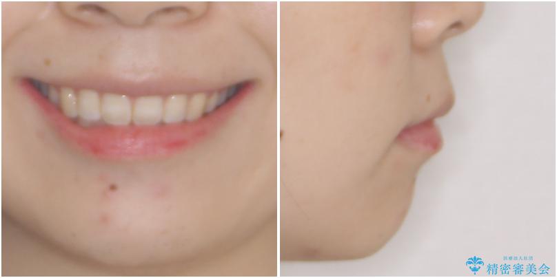 口元の突出感改善　なるべく銀歯を抜歯してワイヤー矯正の治療後（顔貌）