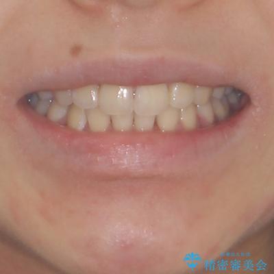 短期間で口元の突出感を改善 ワイヤー装置での抜歯矯正の治療後(顔貌)
