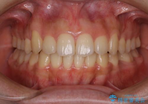 八重歯の解消とインプラントの下準備をインビザラインでの治療後