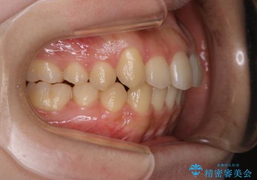 八重歯の解消とインプラントの下準備をインビザラインでの治療後
