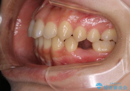 八重歯の解消とインプラントの下準備をインビザラインでの治療後