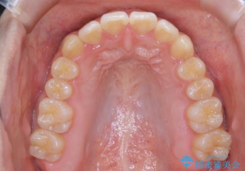 八重歯の解消とインプラントの下準備をインビザラインでの治療後