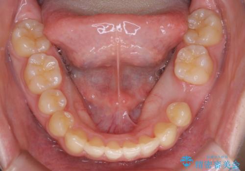 八重歯の解消とインプラントの下準備をインビザラインでの治療後