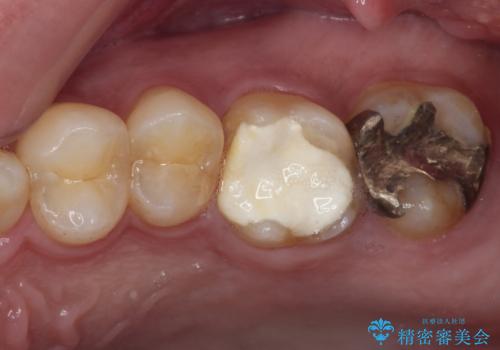 強い咬合力で生じた亀裂からむし歯に　奥歯のゴールドインレー治療の症例 治療前
