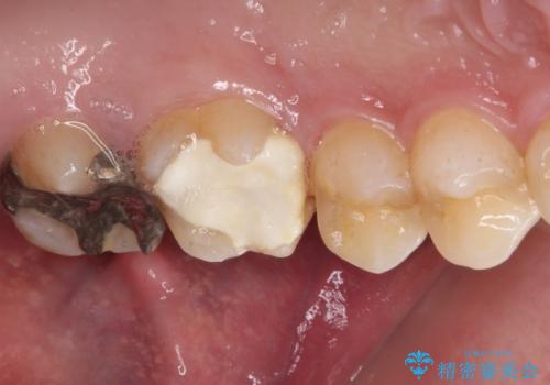 強い咬合力で生じた亀裂からむし歯に 奥歯のゴールドインレー治療の治療前