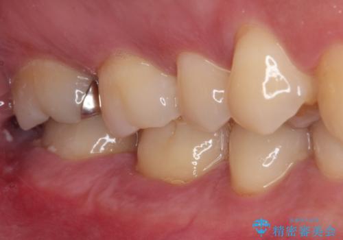 強い咬合力で生じた亀裂からむし歯に　奥歯のゴールドインレー治療の治療前