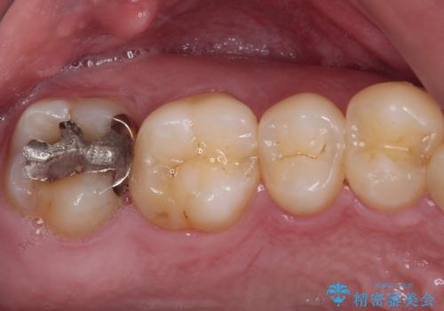 強い咬合力で生じた亀裂からむし歯に 奥歯のゴールドインレー治療の治療前