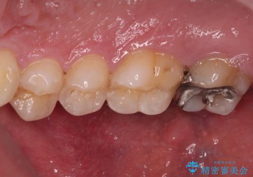 強い咬合力で生じた亀裂からむし歯に 奥歯のゴールドインレー治療の治療前