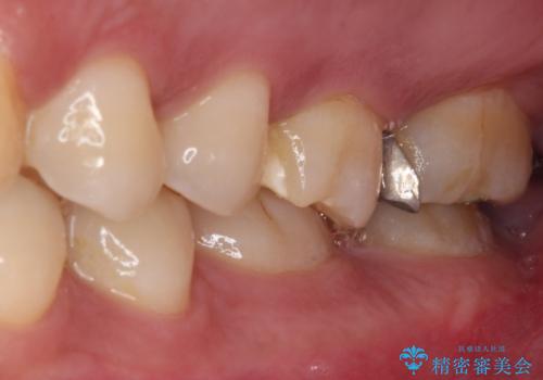 強い咬合力で生じた亀裂からむし歯に 奥歯のゴールドインレー治療の治療前