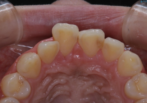 矯正スタートする前のクリーニング(PMTC)の症例 治療前