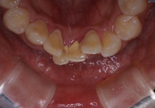 矯正スタートする前のクリーニング(PMTC)の治療前