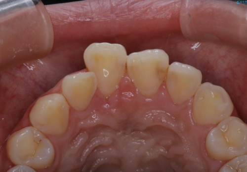 矯正スタートする前のクリーニング(PMTC)の症例 治療後