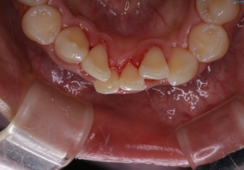 矯正スタートする前のクリーニング(PMTC)の治療後