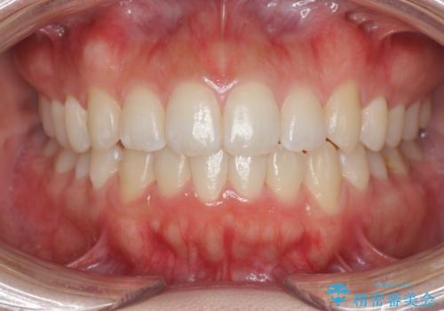 前歯のすれ違い インビザラインで行うマウスピース矯正の治療後