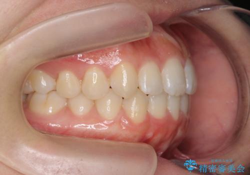 前歯のすれ違い インビザラインで行うマウスピース矯正の治療後