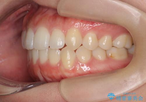 前歯のすれ違い　インビザラインで行うマウスピース矯正の治療後