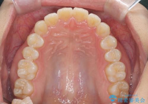 前歯のすれ違い インビザラインで行うマウスピース矯正の治療後