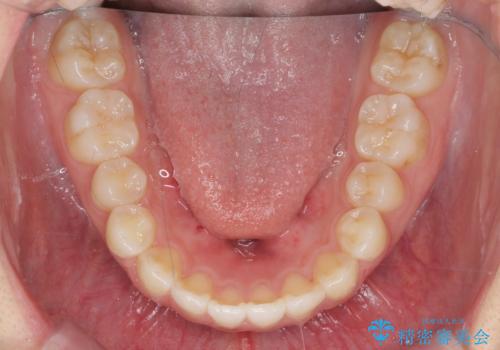 前歯のすれ違い インビザラインで行うマウスピース矯正の治療後