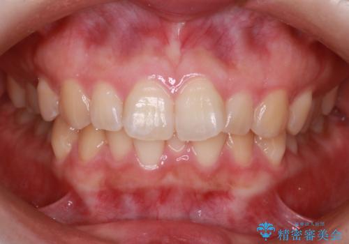 【インビザライン】前歯が出てるのを治したいの症例 治療前