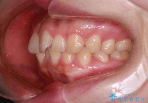 【インビザライン】前歯が出てるのを治したいの治療前