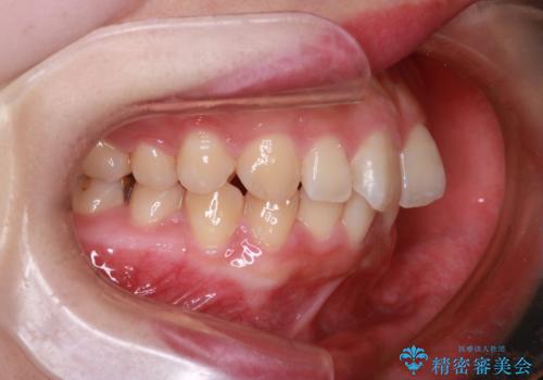 【インビザライン】前歯が出てるのを治したいの治療前