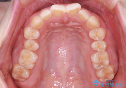 【インビザライン】前歯が出てるのを治したいの治療前
