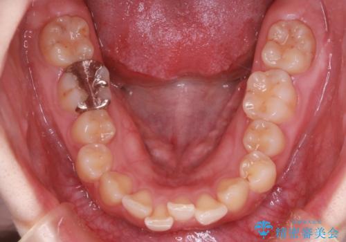 【インビザライン】前歯が出てるのを治したいの治療前