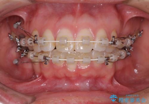 口元の突出感改善 なるべく銀歯を抜歯してワイヤー矯正の治療中