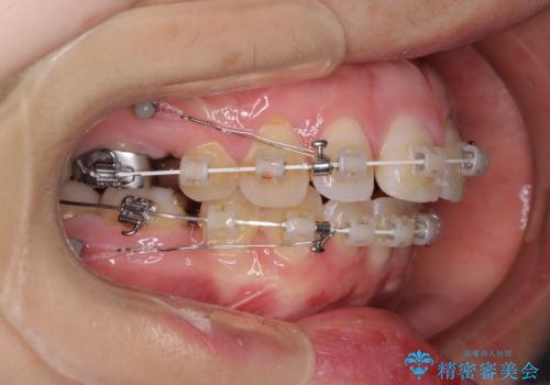 口元の突出感改善　なるべく銀歯を抜歯してワイヤー矯正の治療中