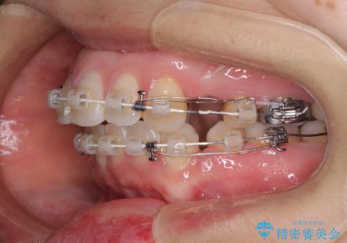 口元の突出感改善 なるべく銀歯を抜歯してワイヤー矯正の治療中