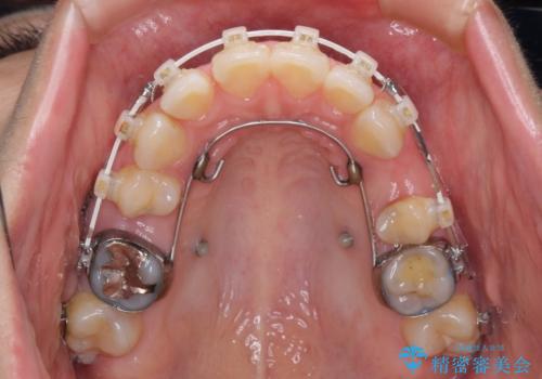 口元の突出感改善 なるべく銀歯を抜歯してワイヤー矯正の治療中