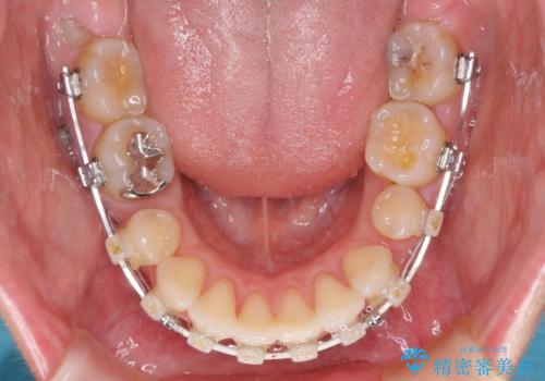 口元の突出感改善 なるべく銀歯を抜歯してワイヤー矯正の治療中