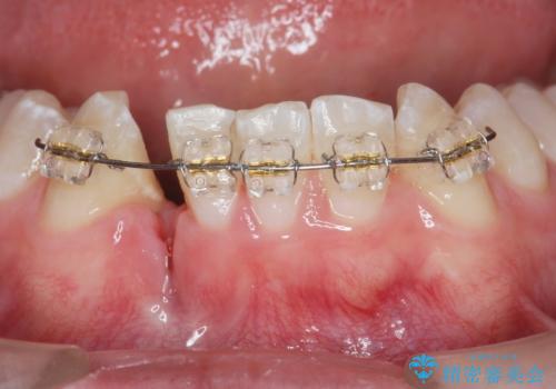 クロスバイト・歯並びが原因の歯肉退縮歯、矯正治療による審美性の改善