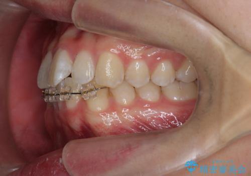 クロスバイト・歯並びが原因の歯肉退縮歯、矯正治療による審美性の改善の治療中