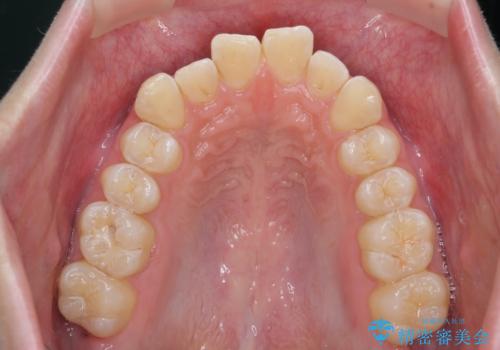 クロスバイト・歯並びが原因の歯肉退縮歯、矯正治療による審美性の改善の治療中