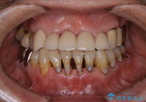 空気が漏れて喋りづらい:適合の良いセラミックで歯をつくるの治療前