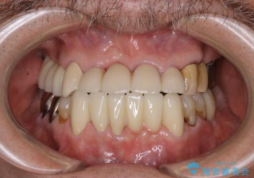 空気が漏れて喋りづらい:適合の良いセラミックで歯をつくるの治療後