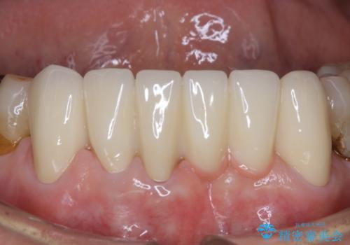 空気が漏れて喋りづらい:適合の良いセラミックで歯をつくるの治療後
