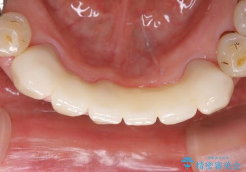 空気が漏れて喋りづらい:適合の良いセラミックで歯をつくるの治療後