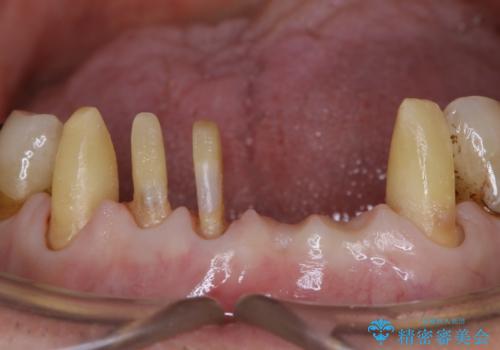 空気が漏れて喋りづらい:適合の良いセラミックで歯をつくるの治療中